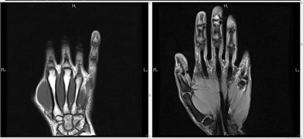 Инженеры создали перчатку МРТ для изучения руки во время движения
