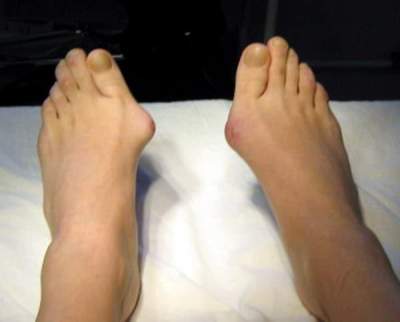 Медики рассказали, как правильно лечить «косточку» на ногах